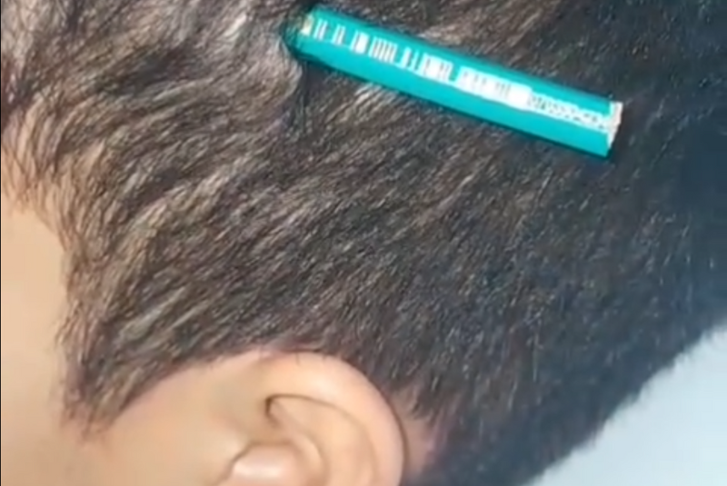 Um estudante da rede municipal de ensino de Praia Grande feriu um colega de classe ao cravar um lápis em sua cabeça durante uma briga.