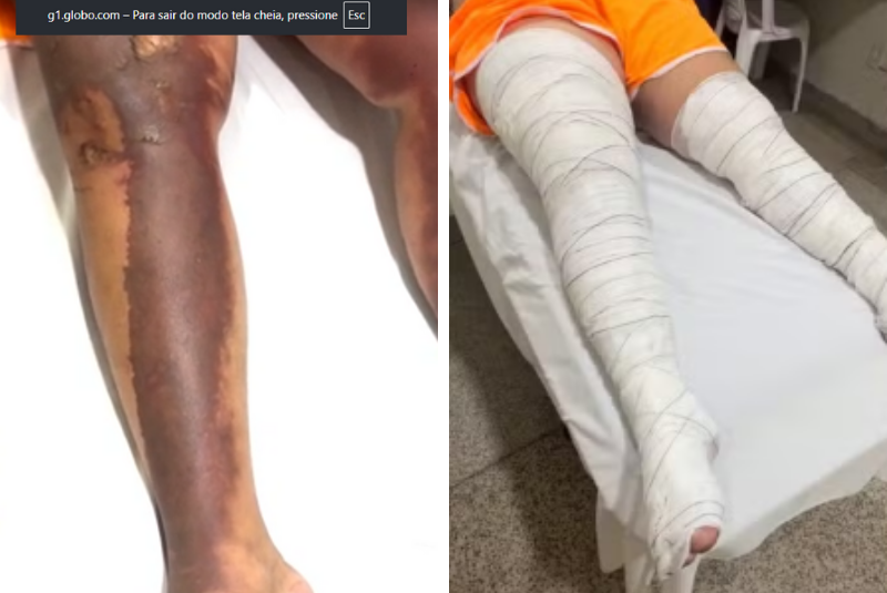 Grávida sofre ataque com gasolina e fogo em Prata, no Triângulo Mineiro, e suspeita faz ameaças nas redes sociais