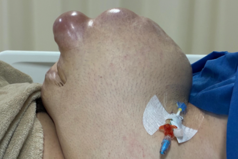 Hérnia Abdominal e Cirurgia Complexa: O caso de Vitor Meireles e sua recuperação
