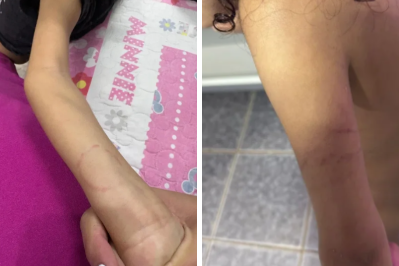 Mãe denuncia maus-tratos e agressões contra filha autista em creche no DF
