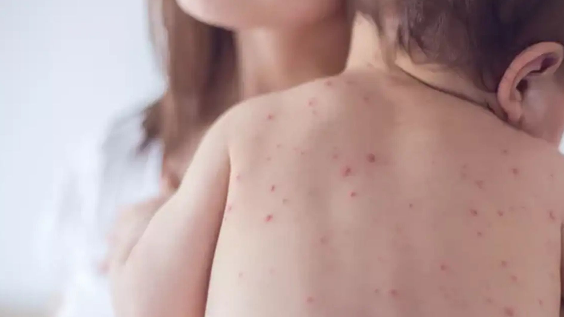 casos de sarampo em São Paulo