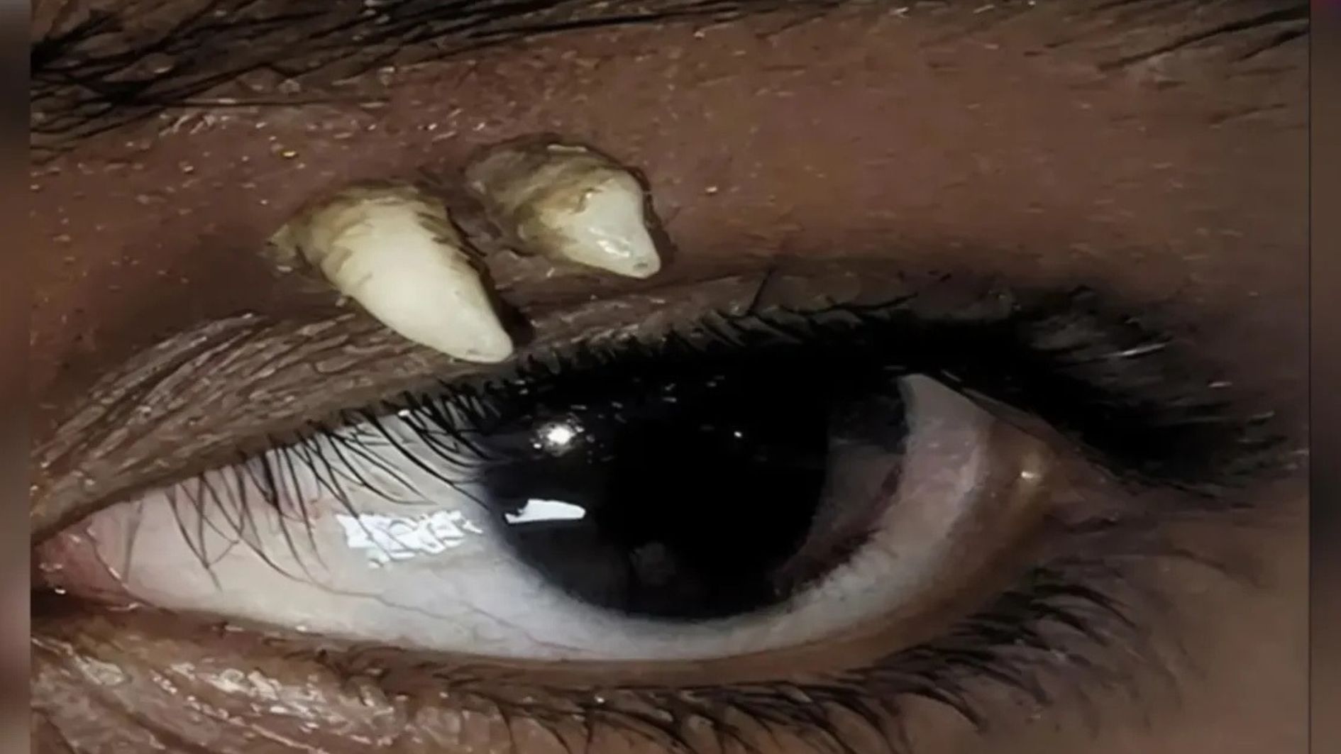 dente ectópico na órbita ocular