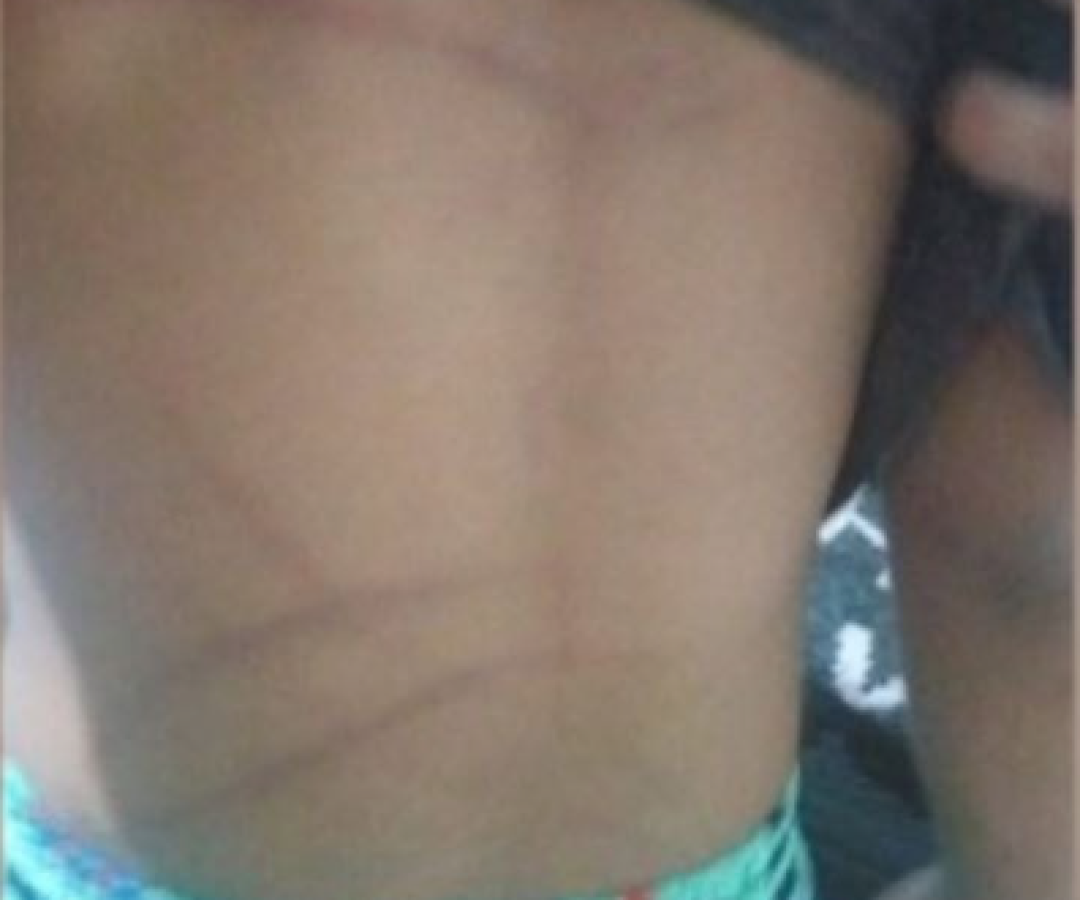 Sinais de agressão nas costas da criança (foto: ascom/PCMG)