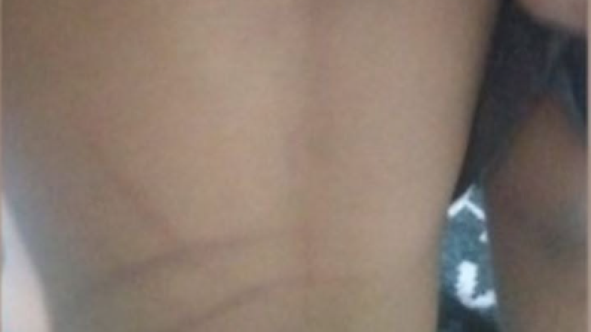 Sinais de agressão nas costas da criança (foto: ascom/PCMG)