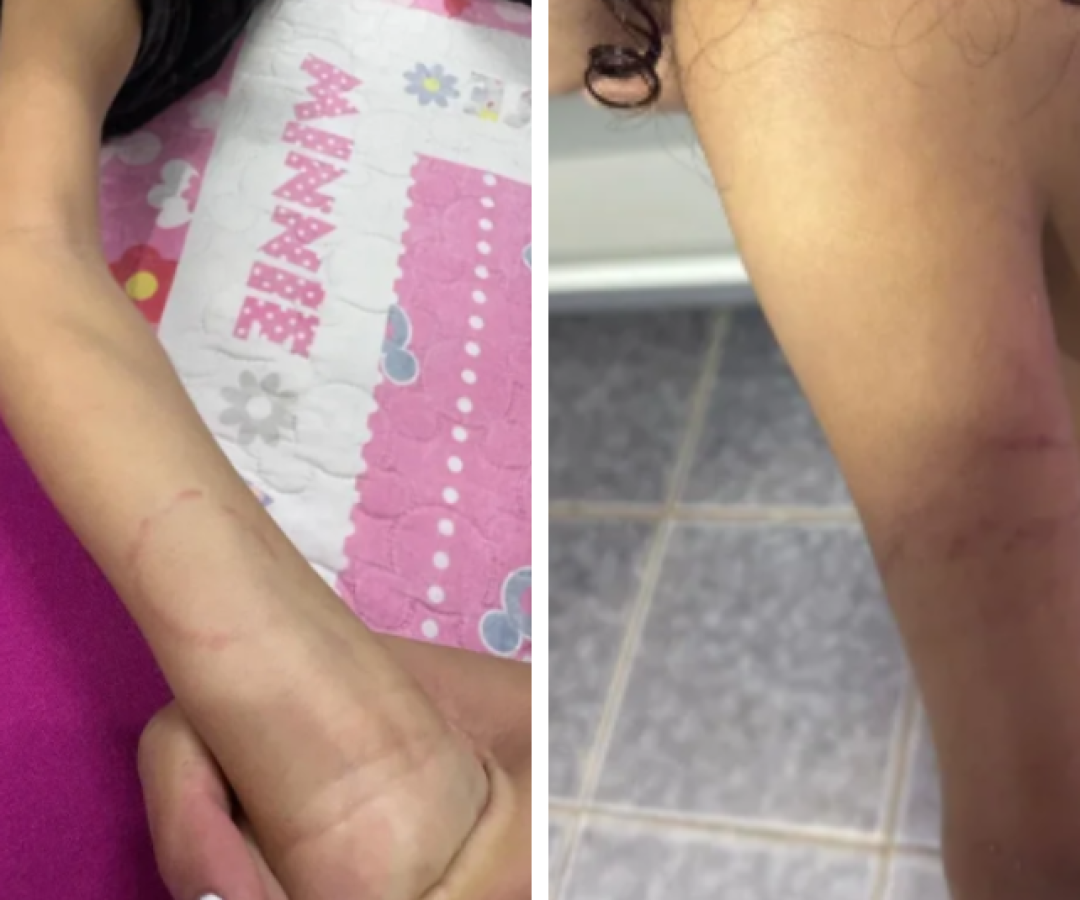 Mãe denuncia maus-tratos e agressões contra filha autista em creche no DF