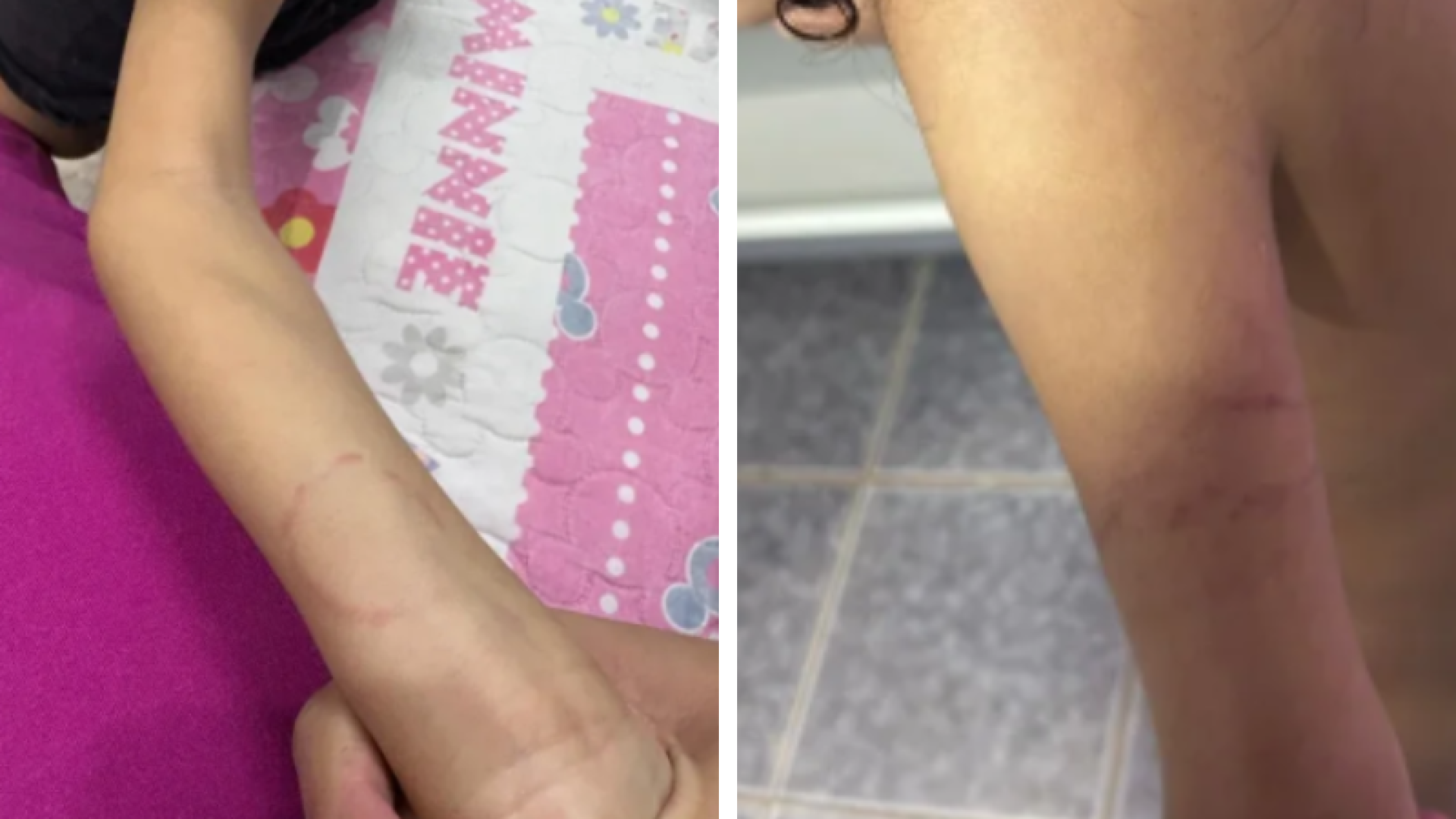 Mãe denuncia maus-tratos e agressões contra filha autista em creche no DF