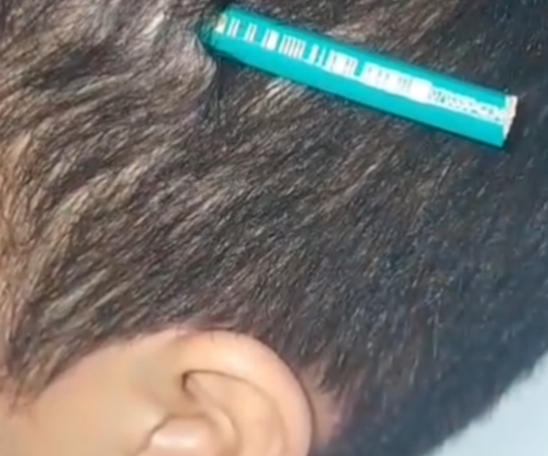 Um estudante da rede municipal de ensino de Praia Grande feriu um colega de classe ao cravar um lápis em sua cabeça durante uma briga.