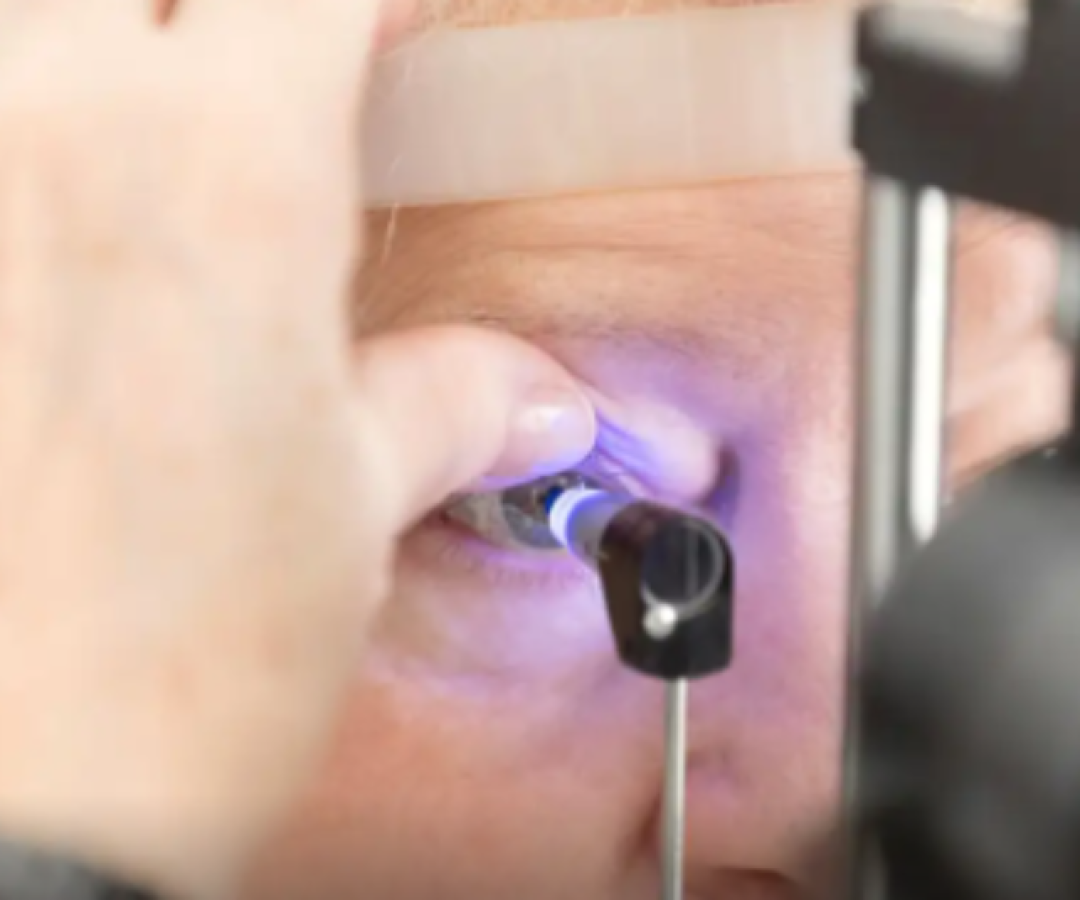 Inteligência artificial pode se tornar aliada no combate ao glaucoma