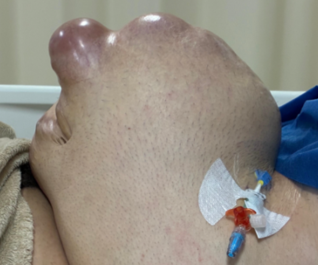 Hérnia Abdominal e Cirurgia Complexa: O caso de Vitor Meireles e sua recuperação