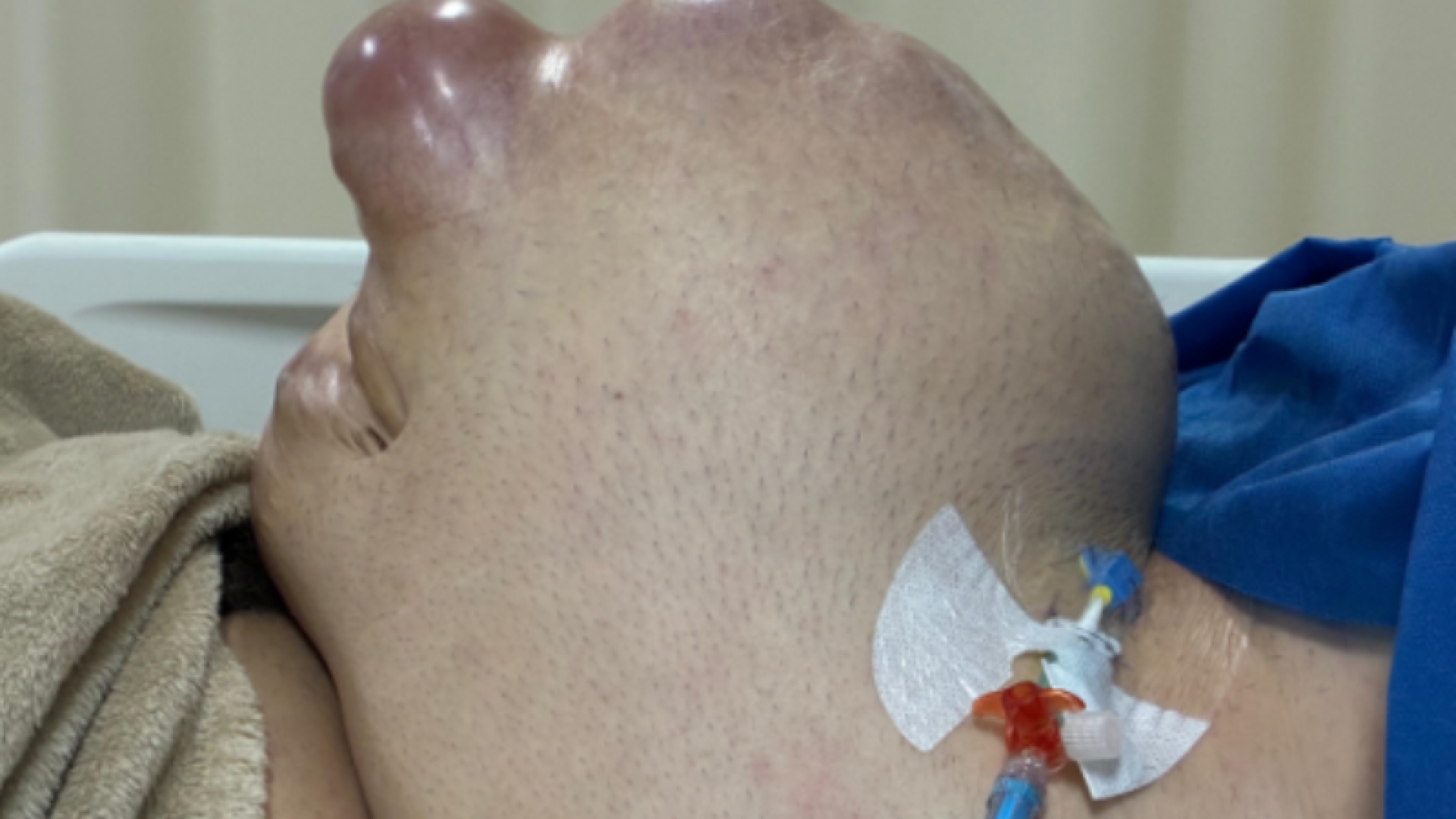 Hérnia Abdominal e Cirurgia Complexa: O caso de Vitor Meireles e sua recuperação