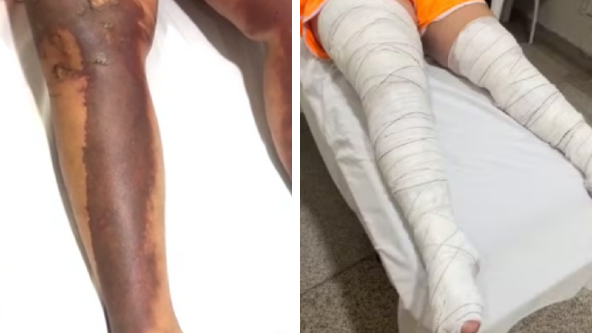 Grávida sofre ataque com gasolina e fogo em Prata, no Triângulo Mineiro, e suspeita faz ameaças nas redes sociais