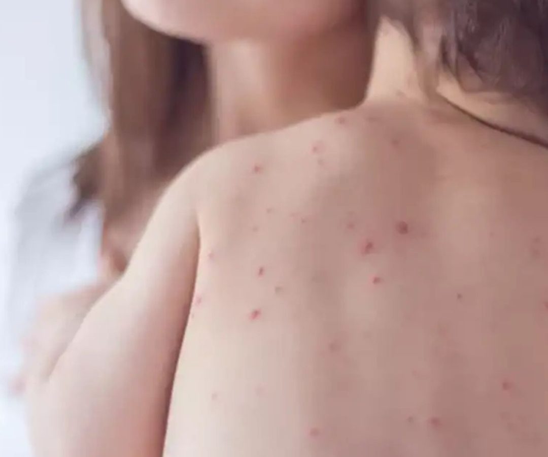 casos de sarampo em São Paulo