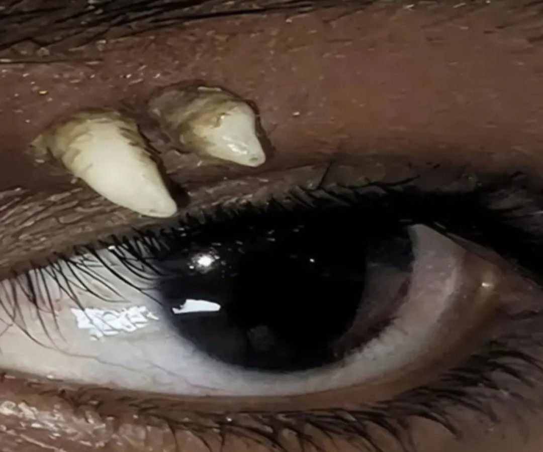 dente ectópico na órbita ocular
