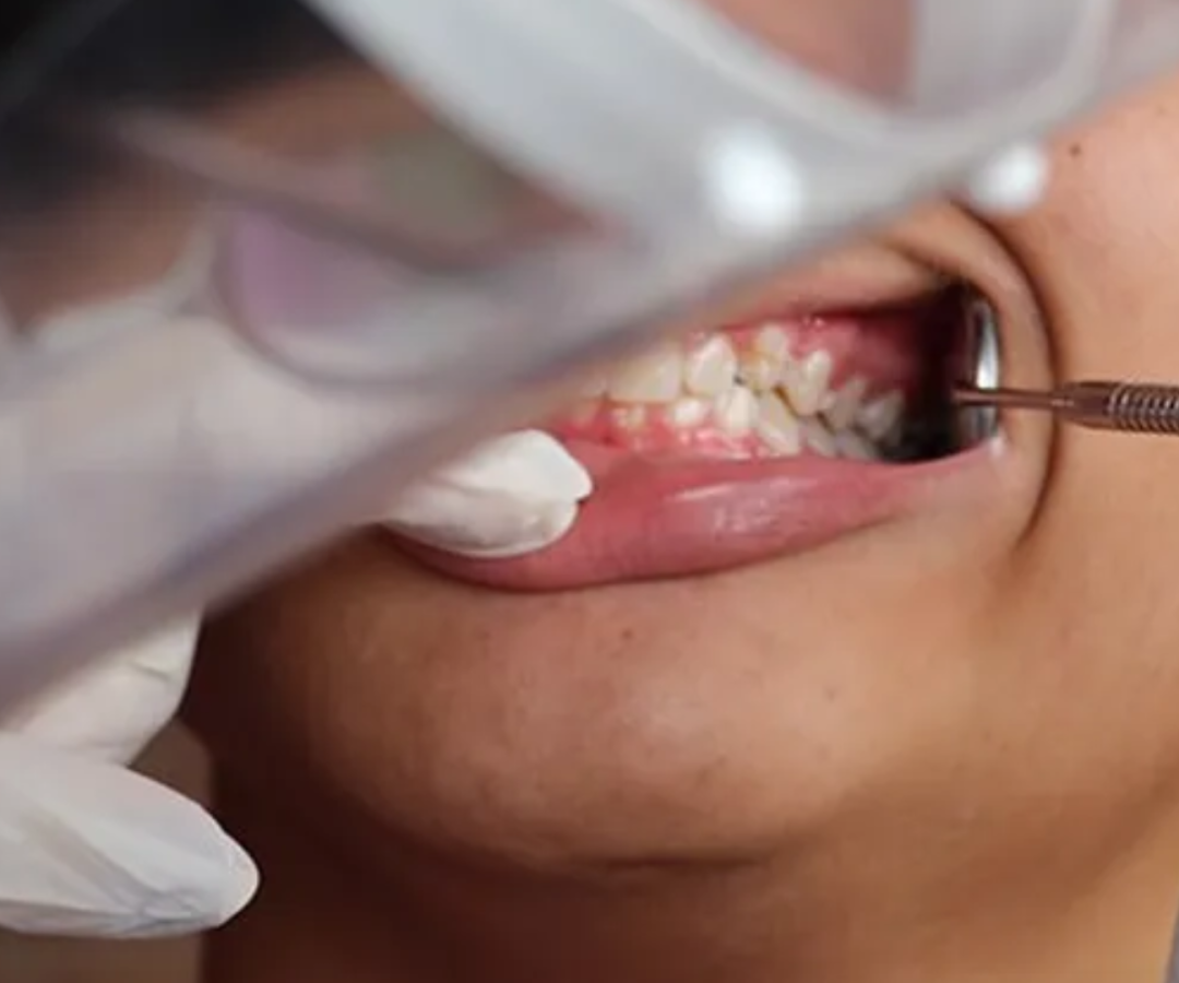 saúde bucal dos brasileiros (Foto: Laísa Queiroz/Ministério da Saúde)